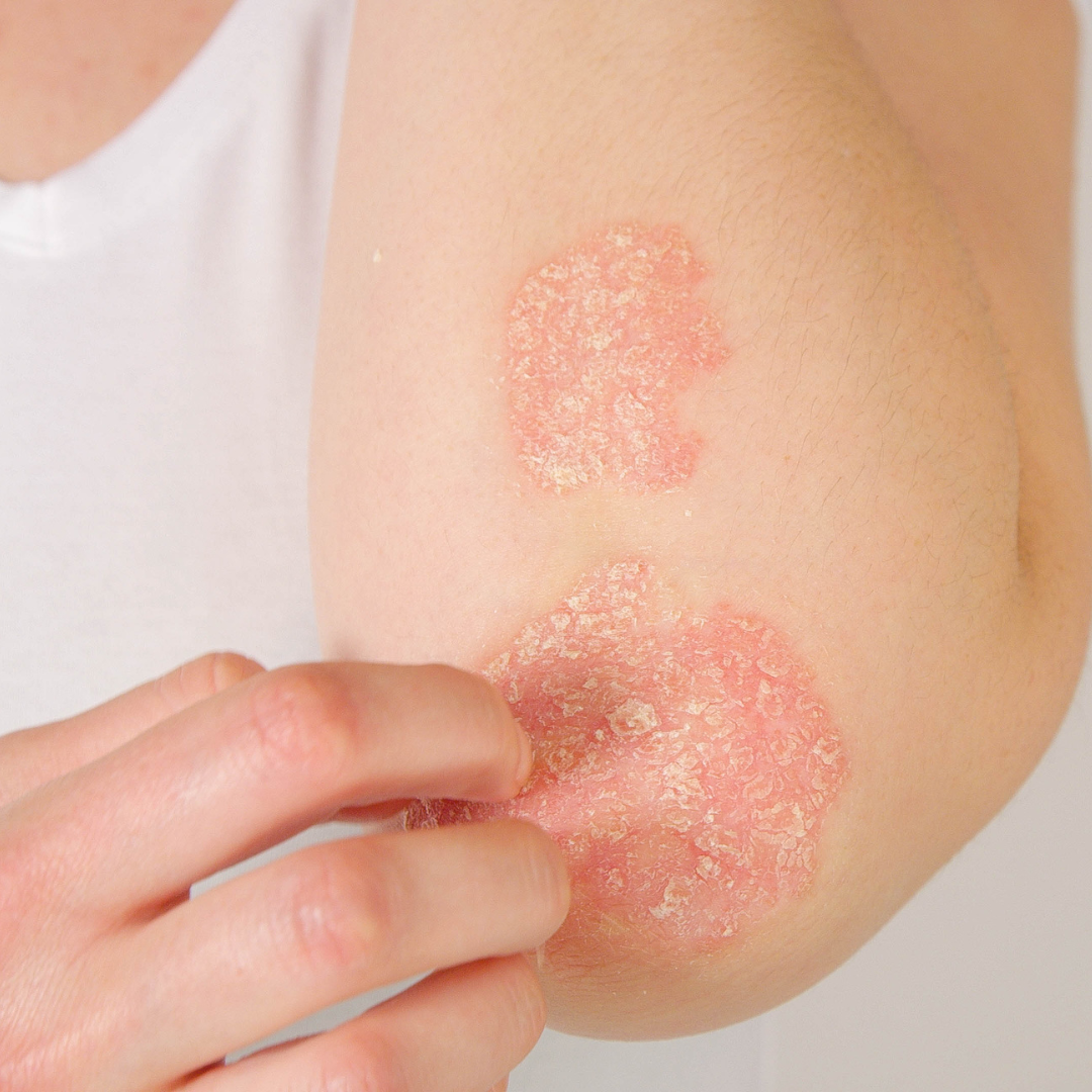 Managing Psoriasis the Natural Way: How Tallow Can Help